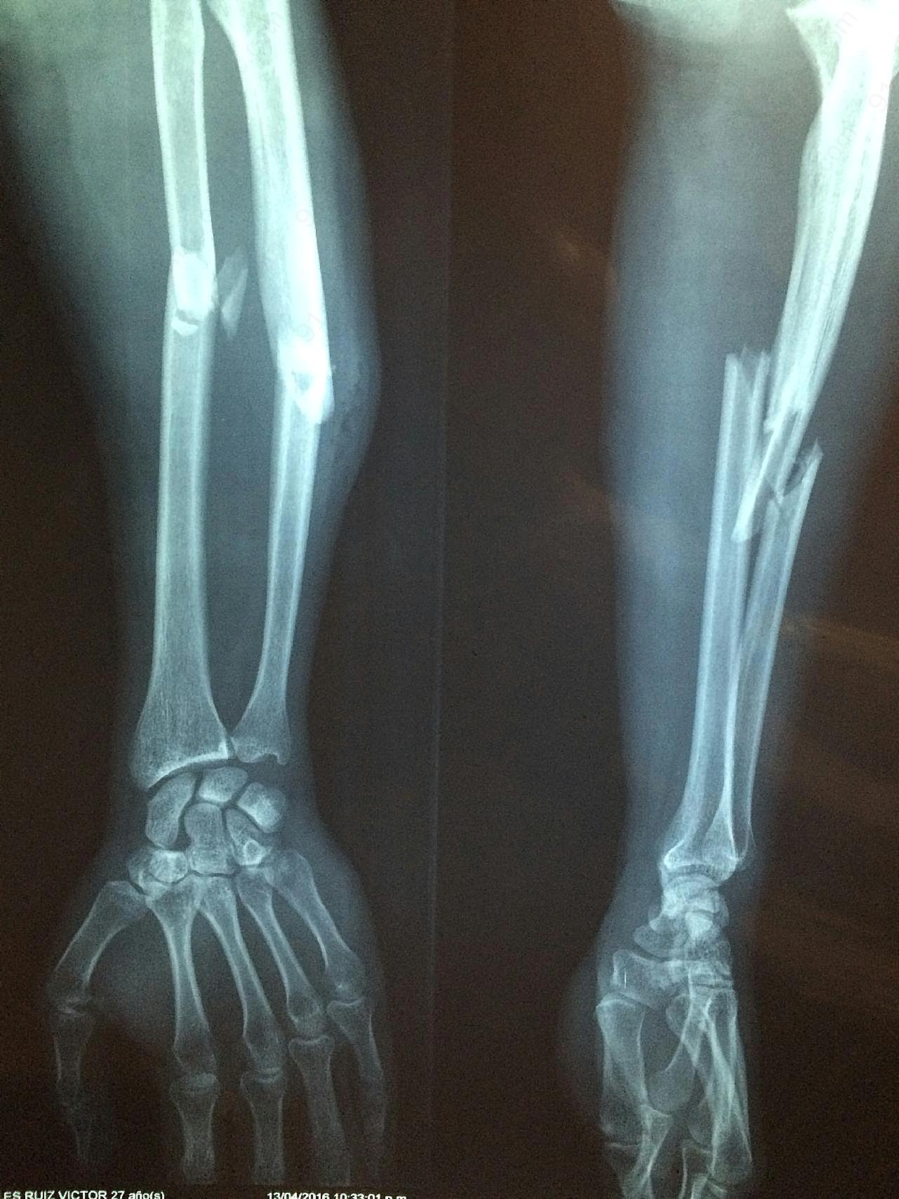 手骨骨折x光片图片摄影